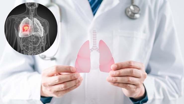 Tumore al polmone sintomi scambiati per altro
