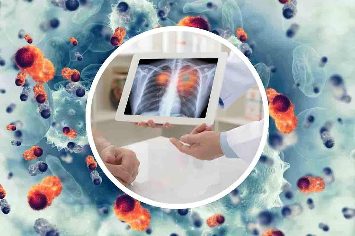 Tumore al polmone, primi sintomi